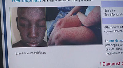 La scarlatine : une maladie contagieuse mais peu dangereuse