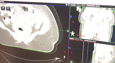 Cancer colorectal : plus de 1000 patients soignés en Martinique